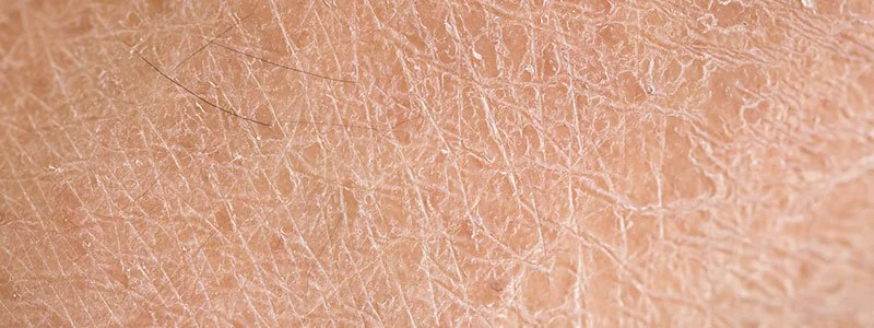dry skin