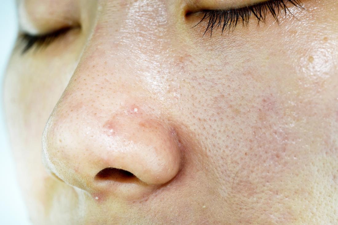 oily skin
