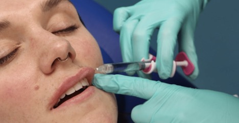 Lip filler techniques